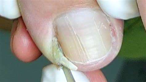 Regular Nail Trims: Why They're Important